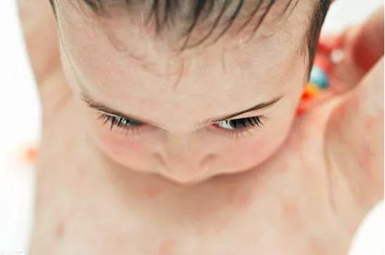 孩子湿疹反复痒到哭，擦药又怕激素？做好这4点，宝宝少受罪