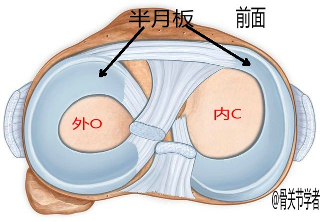 磁共振怎么看半月板损伤程度,磁共振半月板损伤1级是什么