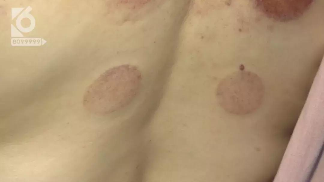 女性湿气太重拔火罐有用吗,拔火罐后有水泡是烫伤还是湿气