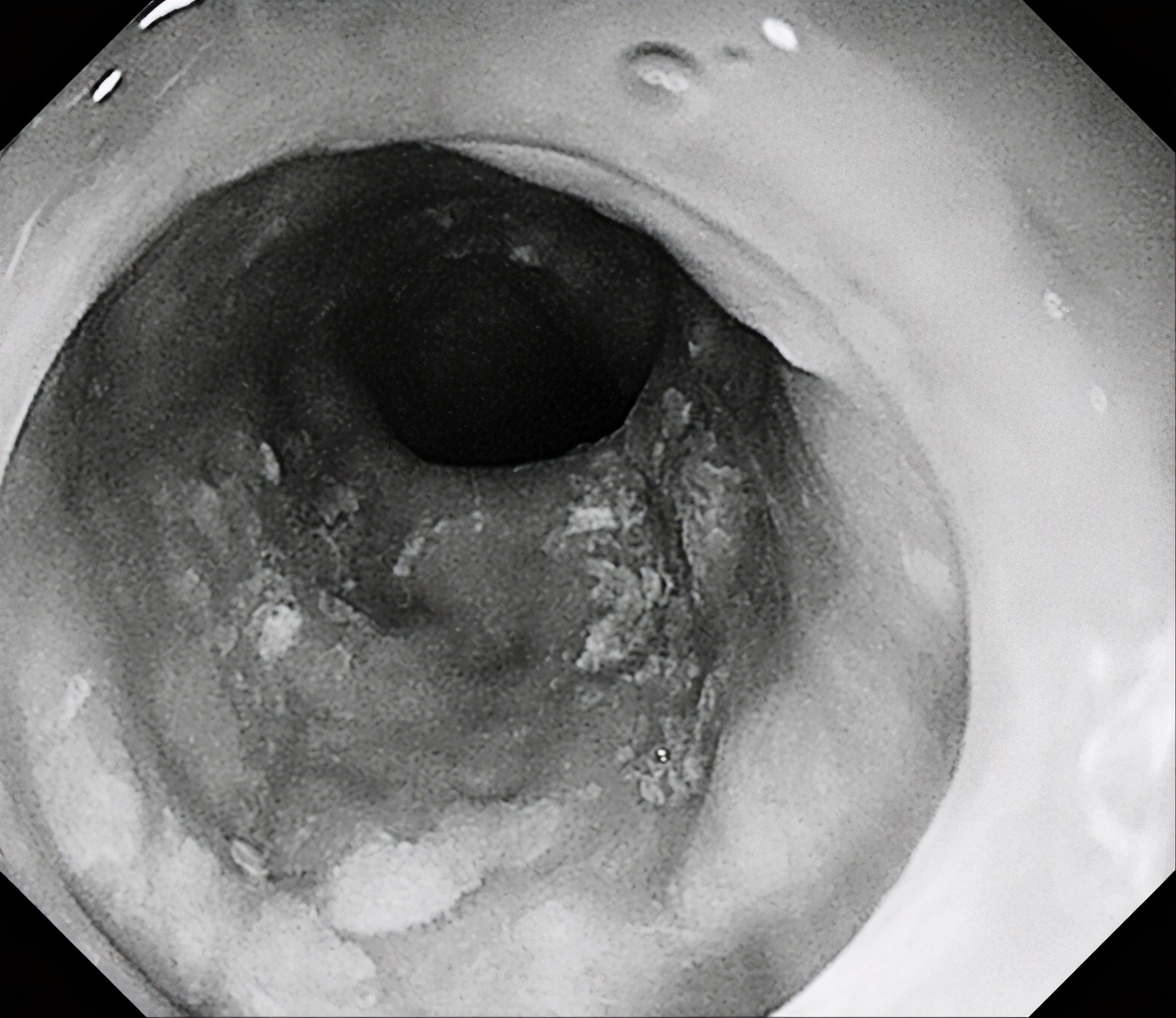 良性肿瘤也可用内镜下黏膜剥离术,内镜下粘膜剥离术后残留肿瘤