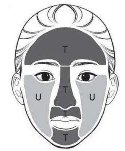 挤压导致的毛孔粗大是不可逆的吗,挤黑头后的毛孔粗大是不可逆的吗