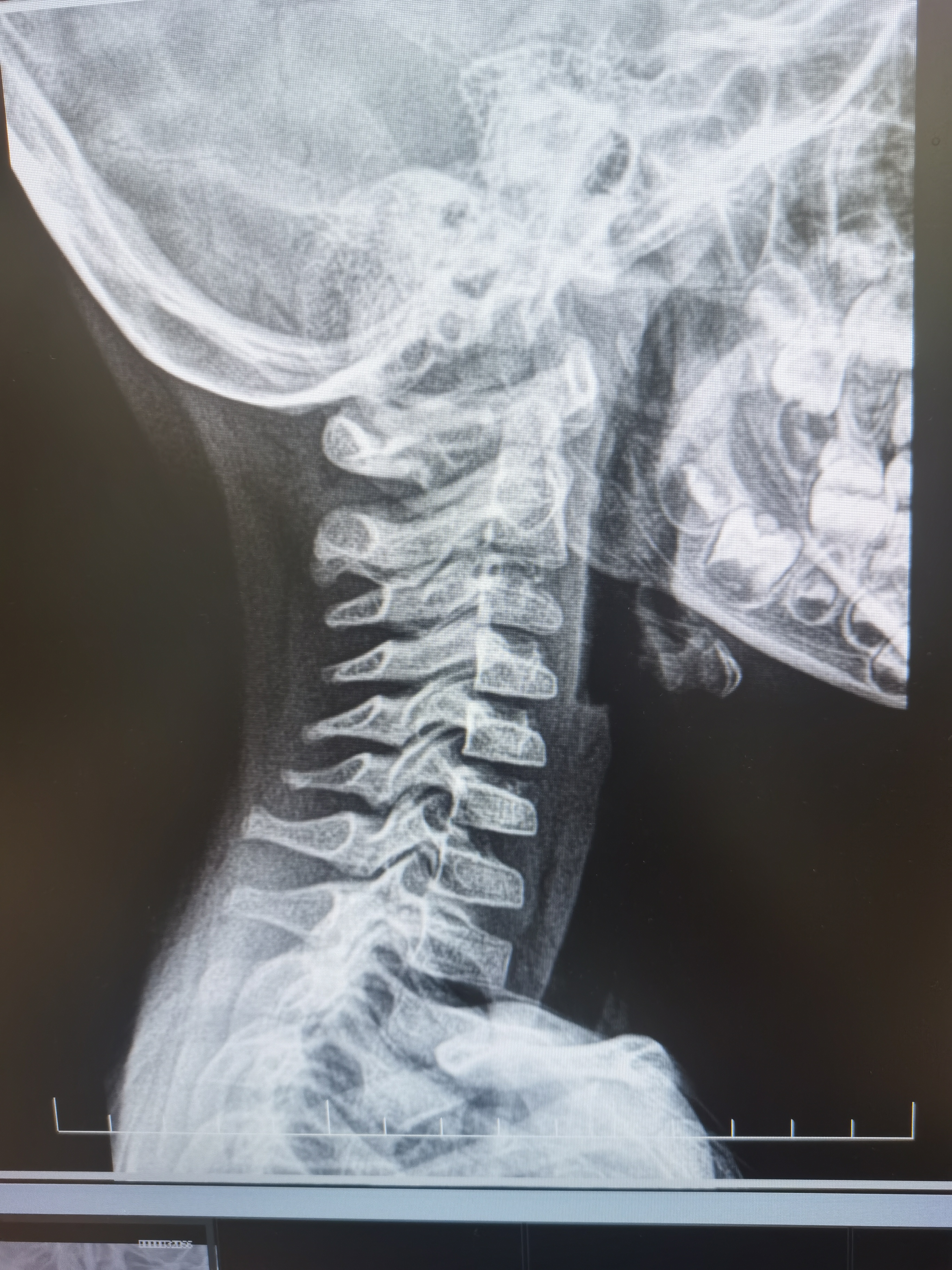 小儿落枕,小儿落枕解决办法图解