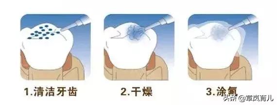 一排牙全拔了可以种牙嘛,牙齿拔光了多久可以种牙