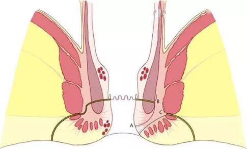 关于肛瘘,关于肛瘘的症状