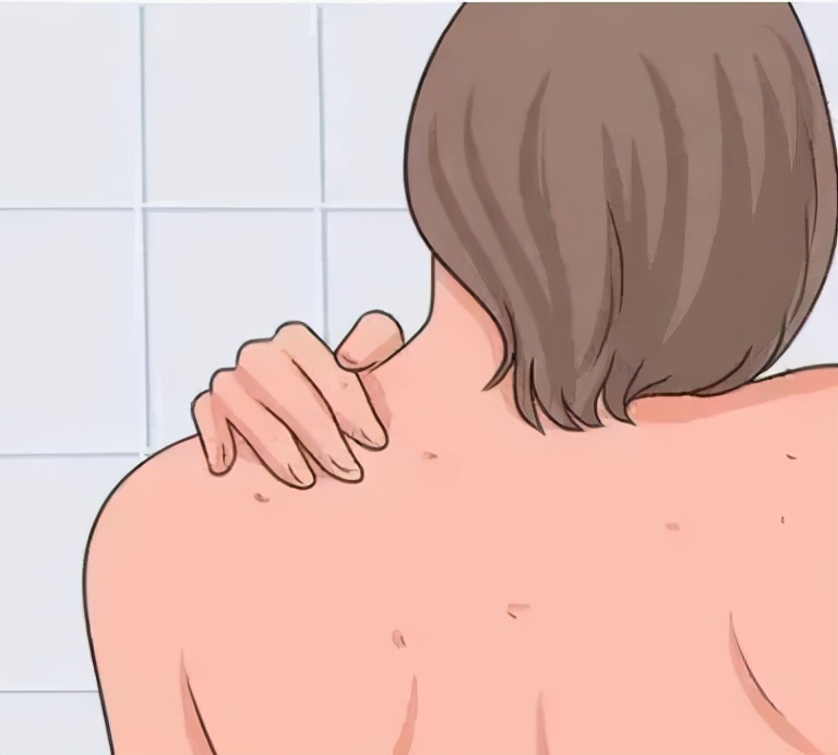 后背长痘最快最有效的方法,背部长痘的治疗方法