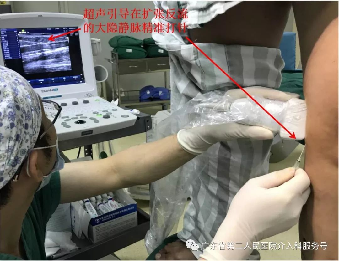 机器引导打针，精准治疗产后静脉曲张