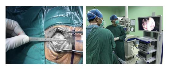 神经外科脑出血微创手术,微创神经介入治疗脑出血后遗症