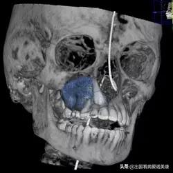 外科多功能助行器,多模态手术室