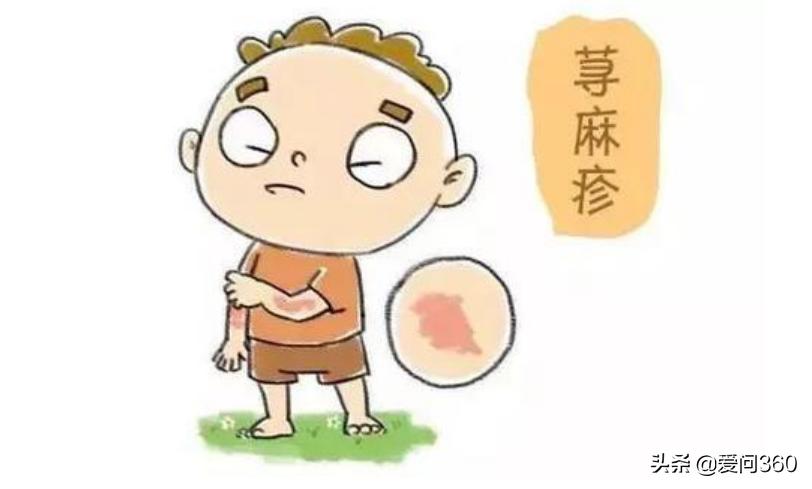 荨麻疹遇热重遇冷缓解怎么治,麻疹出现皮肤瘙痒用什么止痒