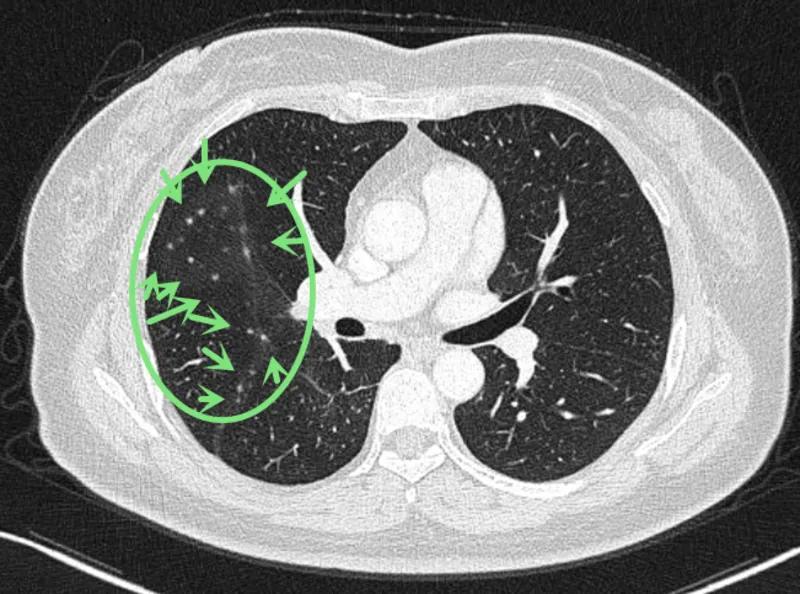 右肺下叶微小结节是什么意思,诊断报告左肺下微小结节没写大小