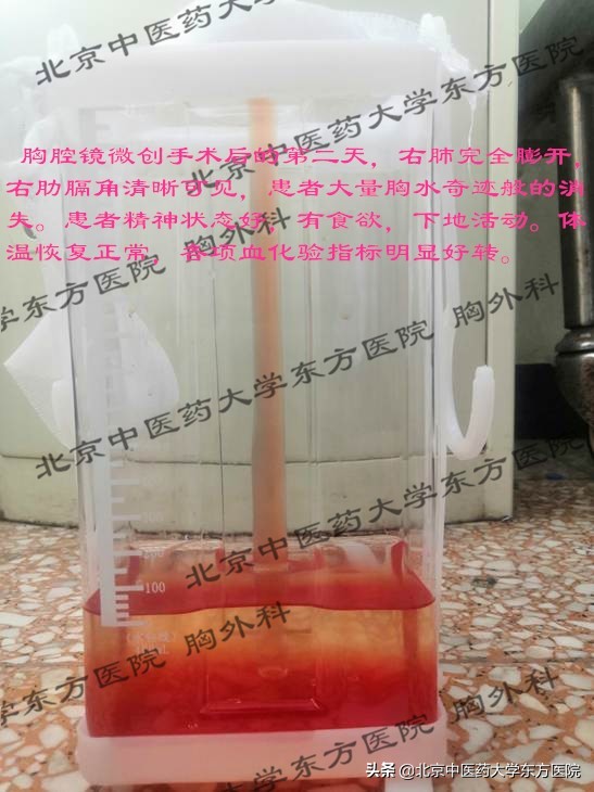 北京治疗胸腔积液哪个医院权威,中医治疗心脏胸腔积液