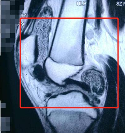 滑膜炎需要治疗吗能自愈吗,滑膜炎怎么治才能彻底治好
