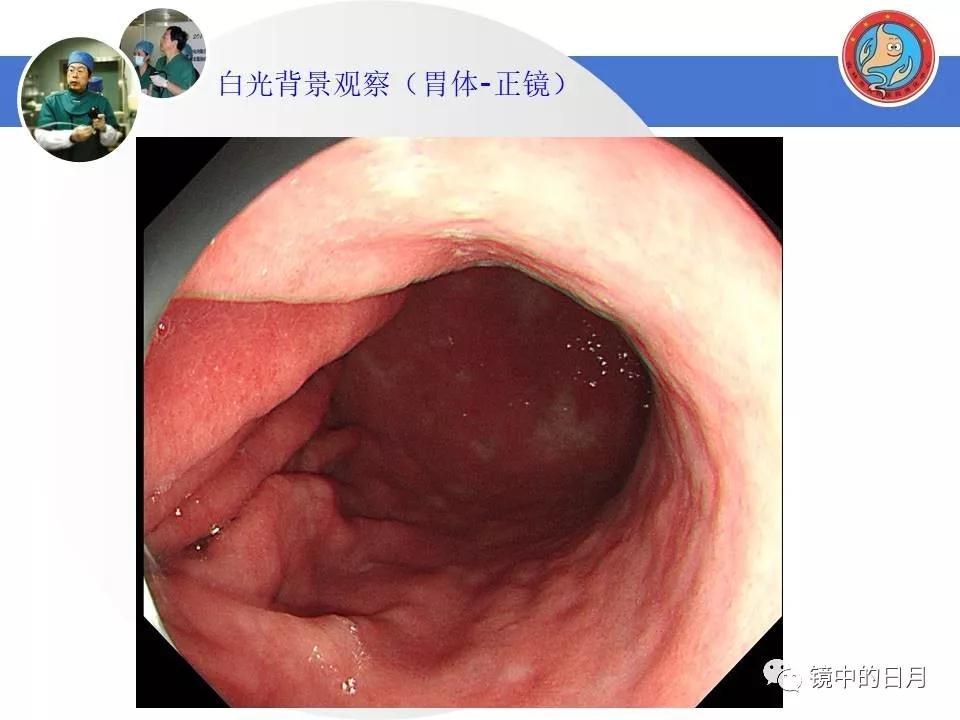 低分化胃癌早期时候做内镜手术吗,早期胃癌内镜手术后追加外科手术