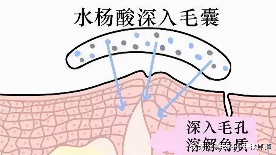 刷酸爆闭口要不要继续刷,刷酸祛闭口几天能有效果