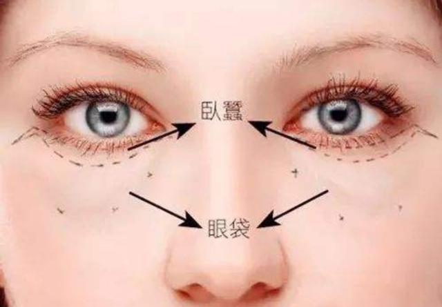去眼袋做卧蚕全过程,去眼袋能让卧蚕更明显嘛