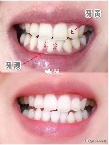 不花一分钱怎样快速祛痘,不花一分钱轻松祛斑