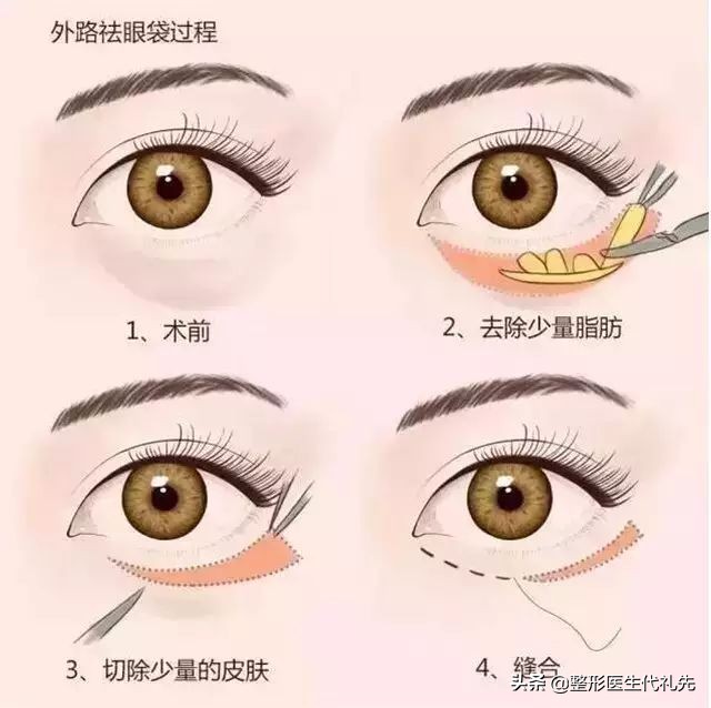 聊一聊35岁外切祛眼袋案例,为什么选择了外切而没有内切祛眼袋