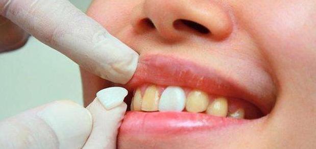 揭露欧美明星牙齿美白的秘密,牙齿美白最好的方法大黄牙