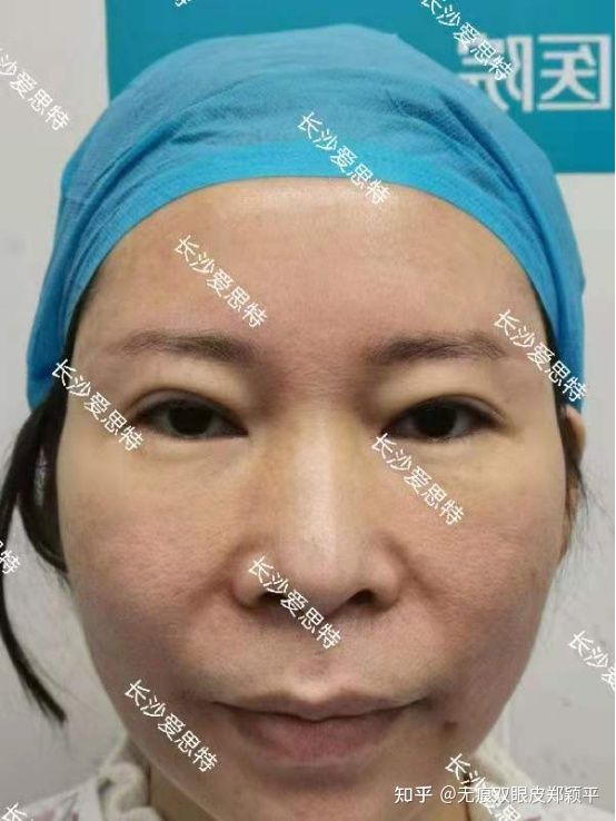 刚割双眼皮的样子,割双眼皮增生是什么样子