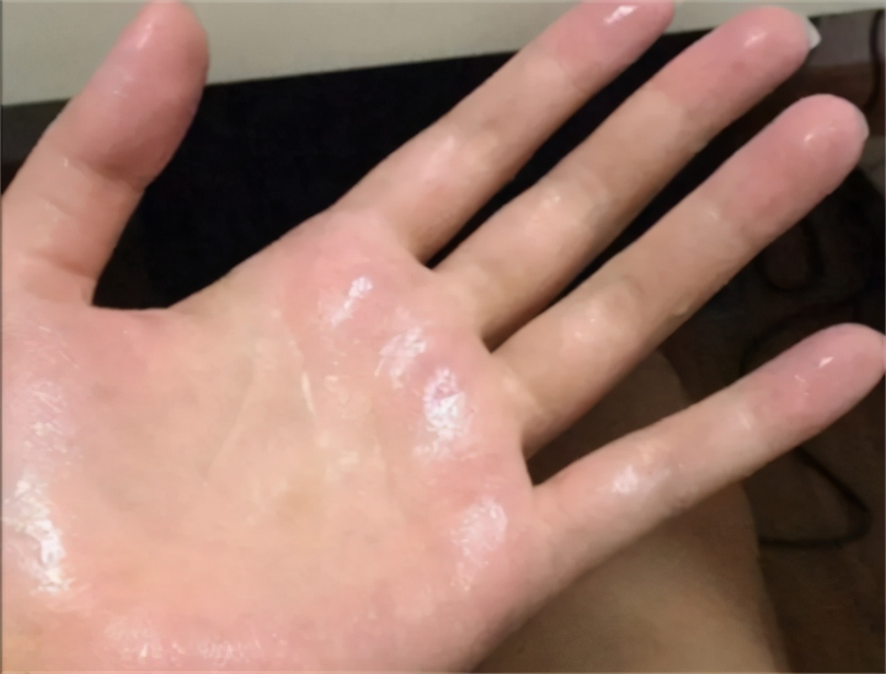 汗手症怎么治疗最有效,治疗手汗症保守的方法