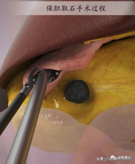 泥沙状胆囊结石2mm吃药可以排出么,有泥沙的胆囊结石能做保胆取石