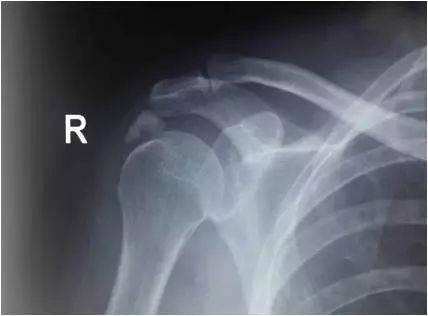 肩膀抬不起来怎么治疗,肩周炎抬不起来胳膊怎么办