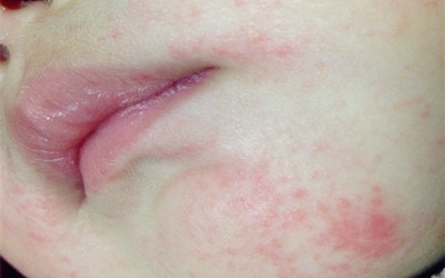 口水疹是什么原因引起的,一岁宝宝严重口水疹