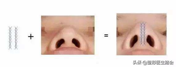 线雕隆鼻的问题,线雕隆鼻的后遗症多久出现