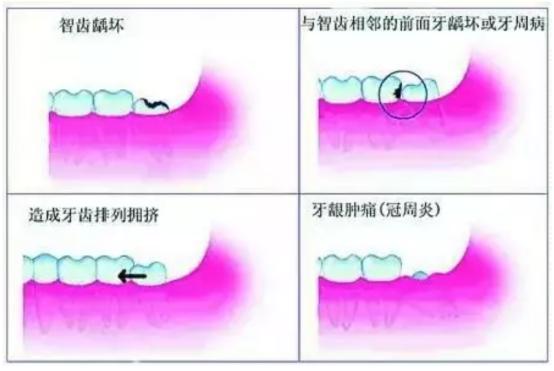 智齿发炎去医院还是去口腔门诊部,口腔知识科普视频智齿