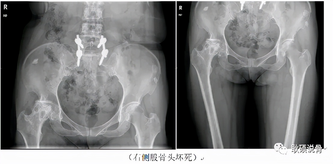 股骨头置换术后切口愈合,股骨头坏死置换第二次手术全过程