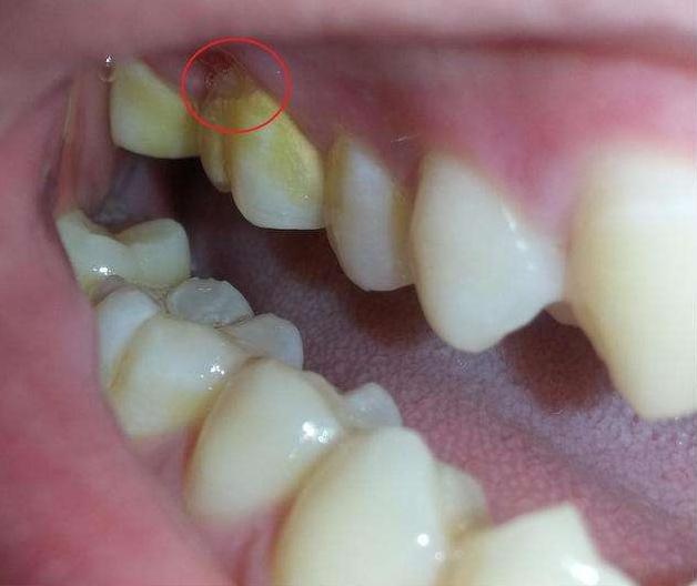 牙结石如何彻底清理干净,自己如何有效的清除牙结石