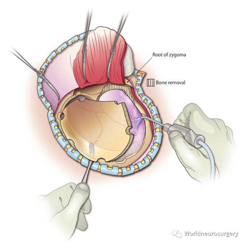 三甲医院治疗肿瘤曝光,脑部肿瘤的最佳治疗方法