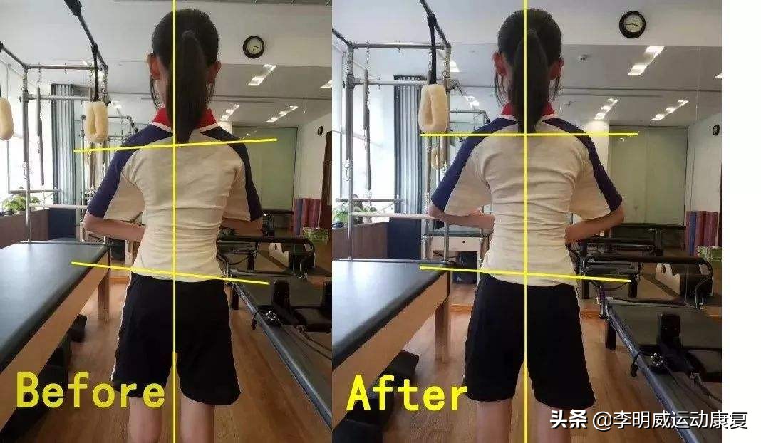 12岁孩子体态不正,体态不正导致大小脸