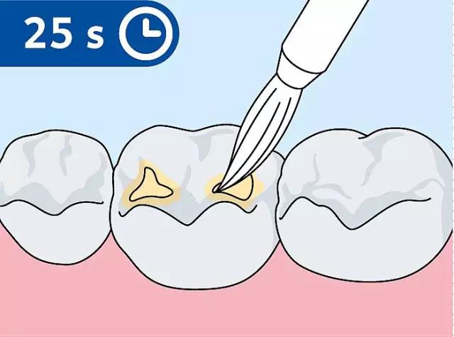 什么是儿童窝沟封闭?会不会痛?1分钟视频带你看懂#雅悦齿科#