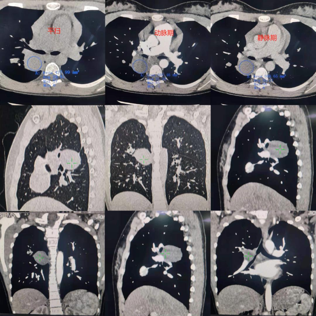 肺内见多发小囊状无纹理透光影,肺内肿块并厚壁空洞