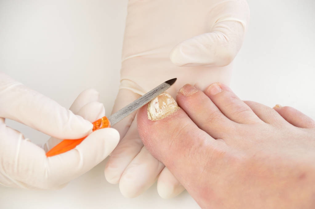 得了灰指甲怎么办这个方法告诉你,灰指甲反复祛根都长不好怎么办