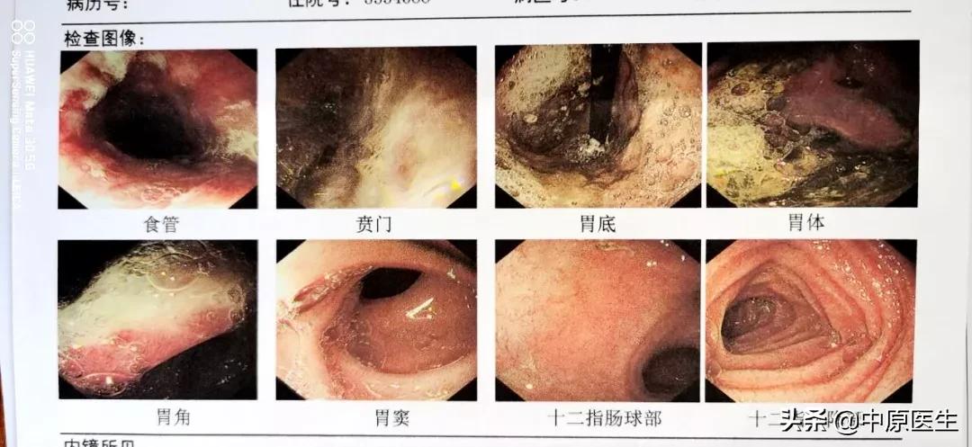 洪水过后，新乡一家庭未用完的消毒剂被1岁孩子误喝