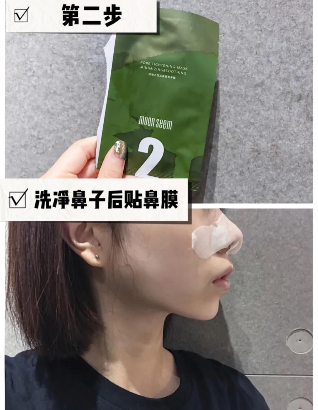 黑头闭口连根拔起,黑头粉刺连根拔起留坑