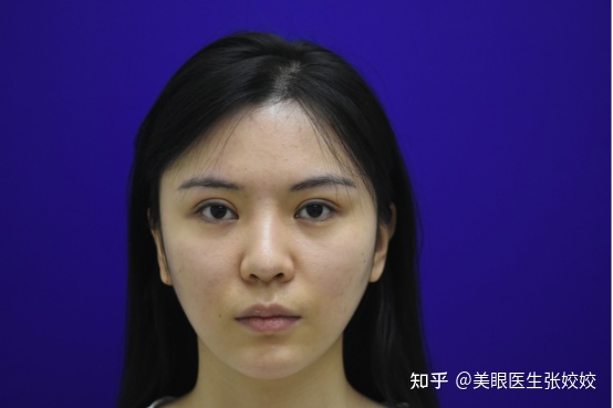 为什么割的双眼皮会显得假,为什么有的双眼皮做出来特别假