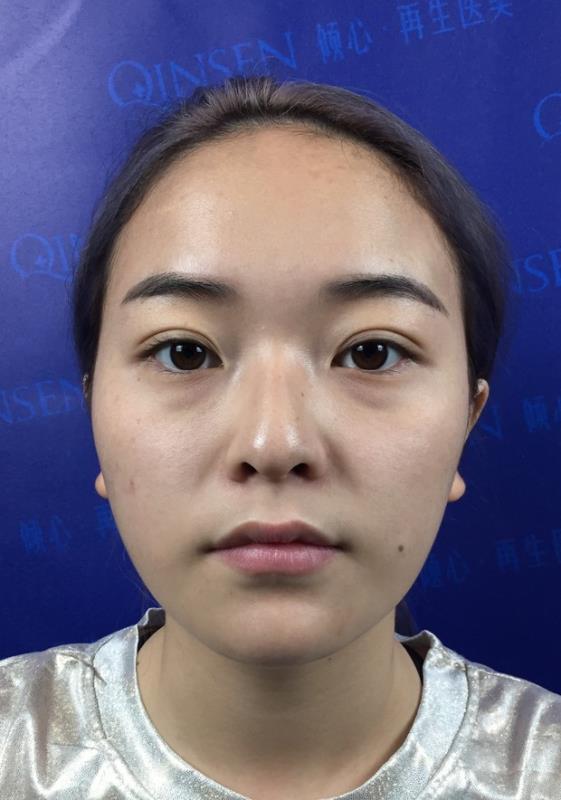 肋骨隆鼻最快的恢复方法,肋骨隆鼻即刻效果