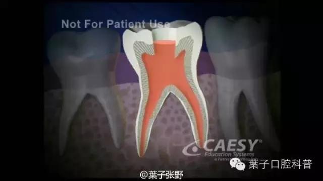 上牙龈上火突出一个鼓包,牙龈肿胀鼓包上火了吗