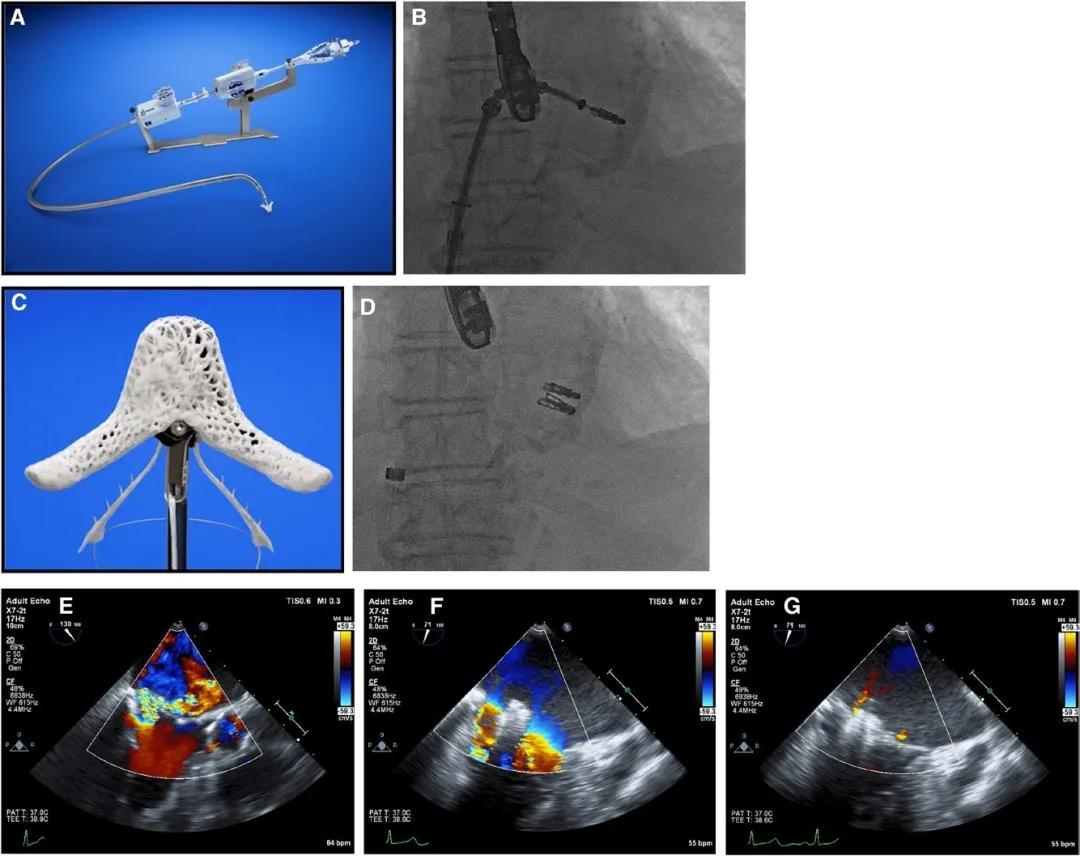 心脏“小门”关不严,经导管二尖瓣介入治疗,不开胸就换瓣
