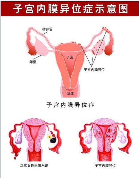 得了子宫内膜异位症该怎么治,什么是子宫内膜异位症呢