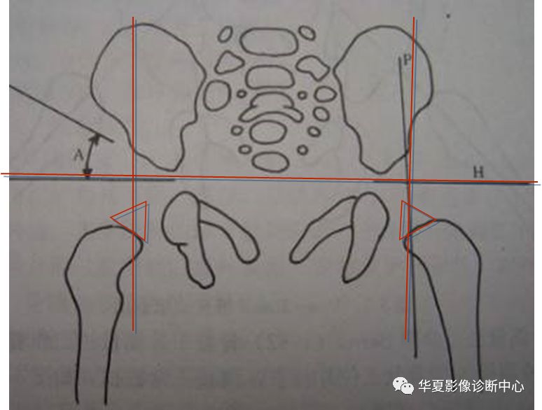 先天性髋关节脱位饮食,先天性髋关节脱位属不属于残疾人