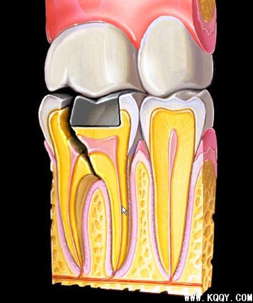 牙烂了一半医生不让拔,牙烂掉并不松动可以拔掉吗