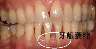 牙龈萎缩造成牙齿很松需要拔掉吗,牙龈萎缩严重导致牙齿掉