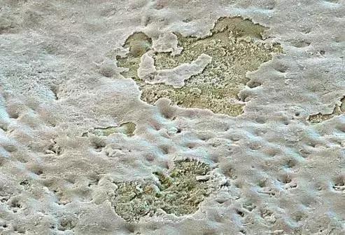 为什么牙齿内部会掉出来一小块,牙齿脱落跟缺钙有关吗