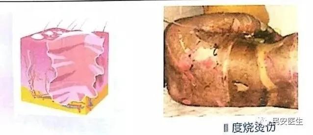 右小腿烧烫伤处理操作视频,老人烧烫伤急救处理方法