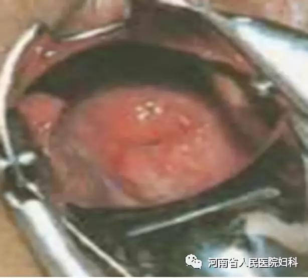 你知道什么是宫颈糜烂吗?