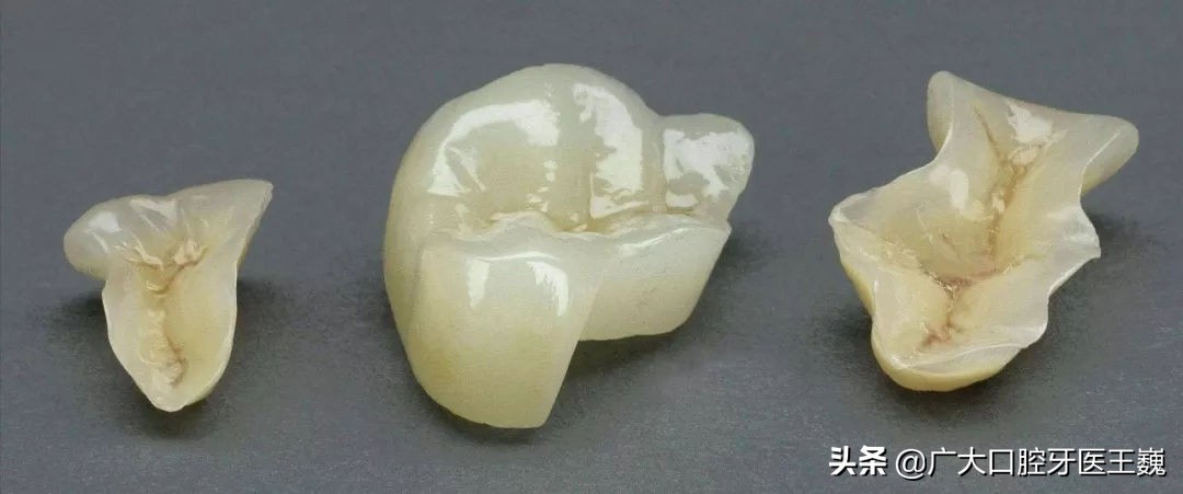 医生建议不拔牙而补牙的好处,牙齿坏得严重建议拔牙还是补牙